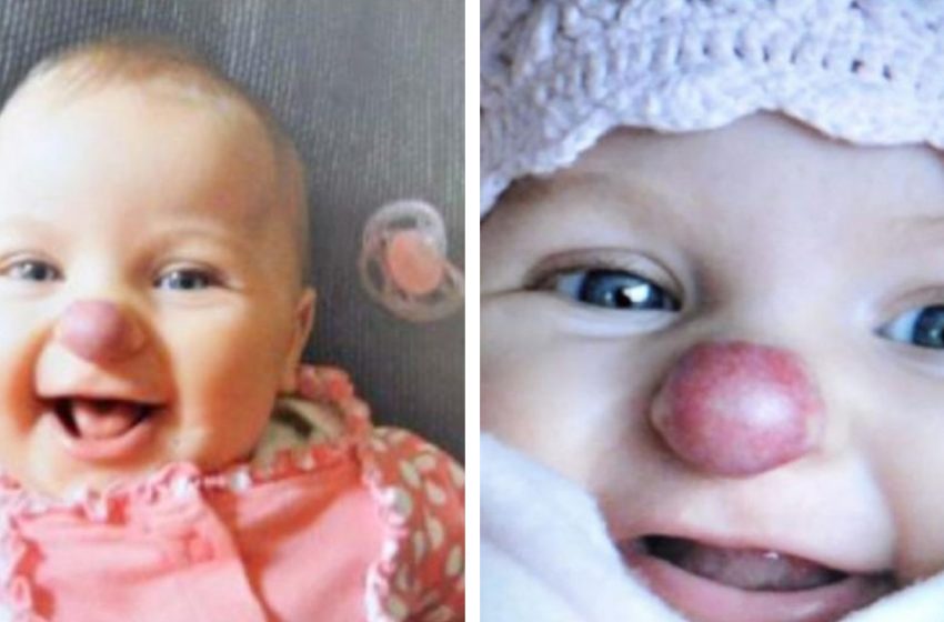  What does a girl who was born with a “clown nose” look like now?