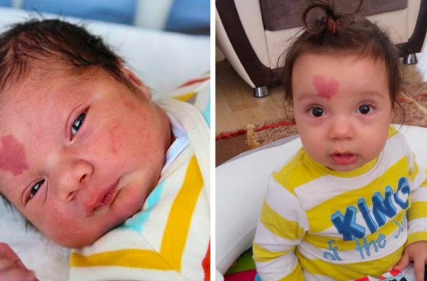  A baby who was born with a birthmark on his forehead in the form of a heart. What does he look like at 6 years old?