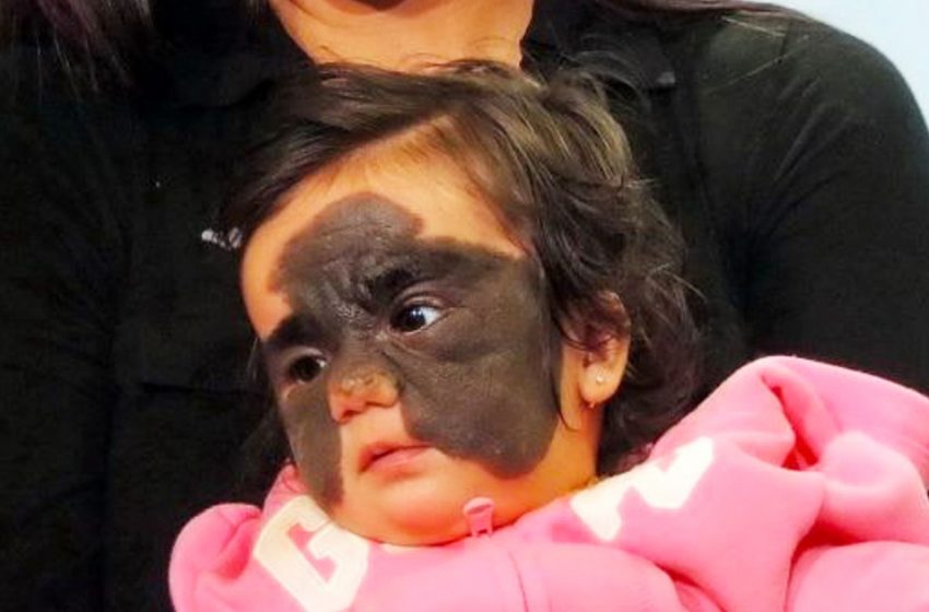  The «mask» is no more. The girl Luna managed to be cured completely