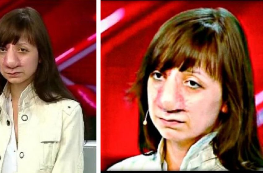  What does Yana Muratova look like now, who survived 19 operations on her nose