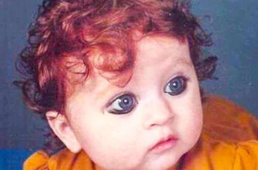  This baby was ridiculed as a child for her unusual appearance. She grew up and was able to accept herself