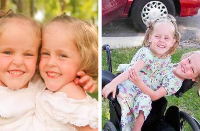  These Siamese twins were separated at 4 years old and are now 18 years old. How do they live now?