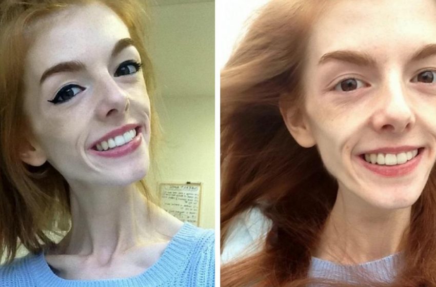  Two years ago, she weighed only 29 kilograms, but an ordinary chocolate bar helped her cure anorexia