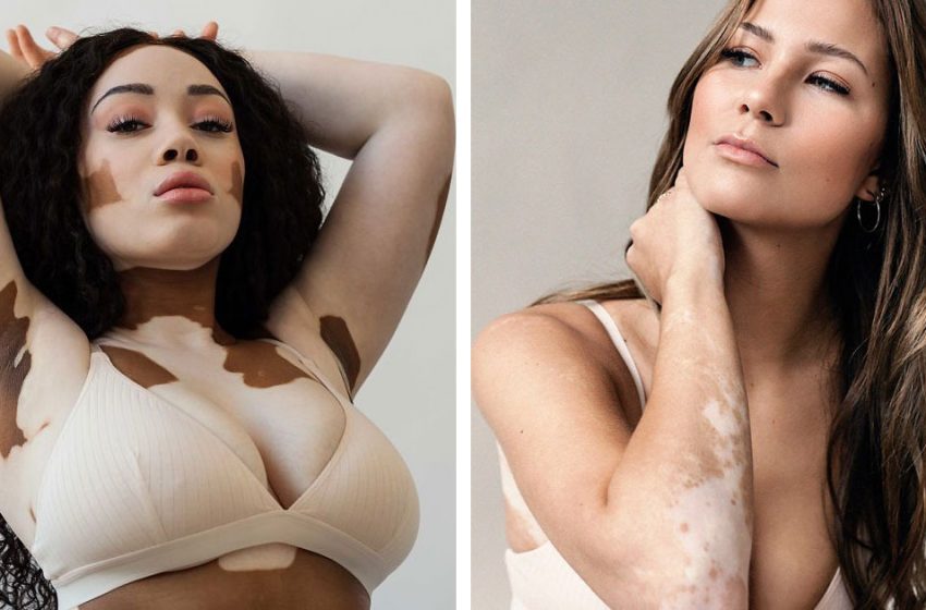  Some amazing examples that vitiligo is not a problem, every girl can become a successful model with it