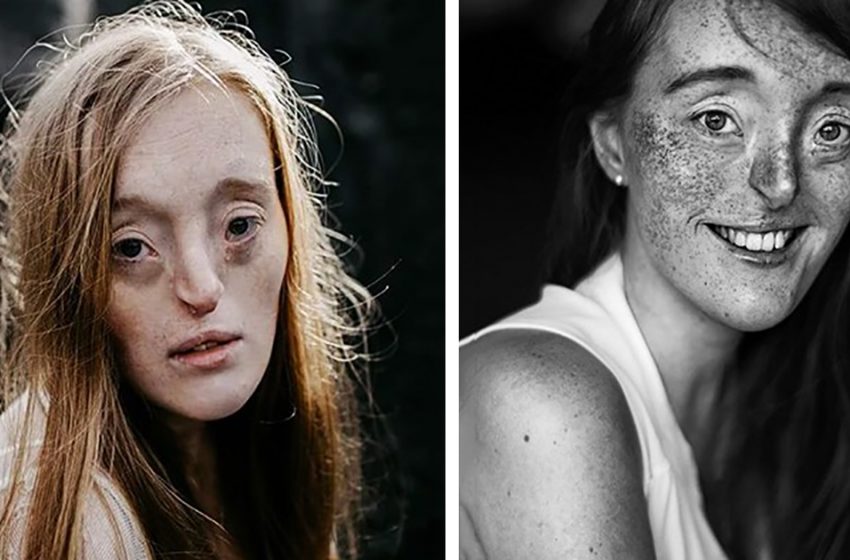  A girl who was bullied as a child has grown up to become a supermodel