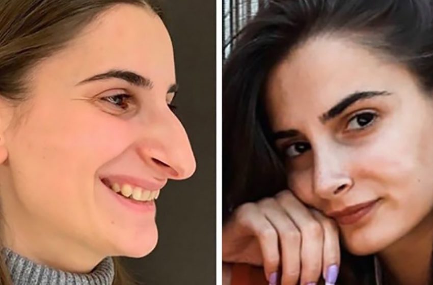  Hanno completamente cambiato aspetto: Foto di ragazze comuni prese dal web, che hanno chiaramente tratto beneficio dalla chirurgia plastica