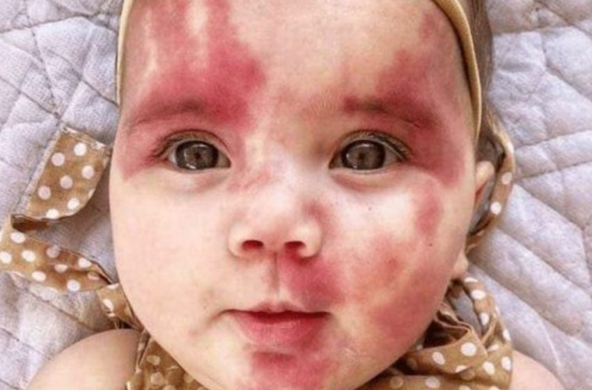  La bambina nata con una macchia a forma di cuore sul viso: com’è il suo aspetto ora