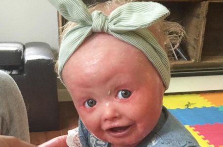 «I genitori sono rimasti scioccati quando hanno visto il viso della loro neonata figlia»: Ora, all’età di 6 anni, è «la ragazza più bella» per loro!