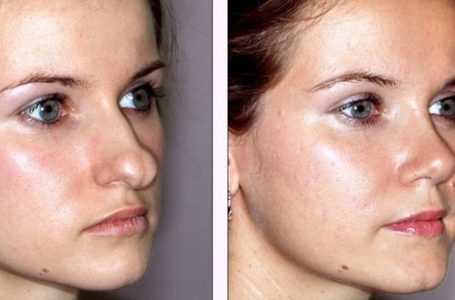 L’aspetto positivo della chirurgia plastica: foto di ragazze che hanno subito interventi per migliorare il loro aspetto!