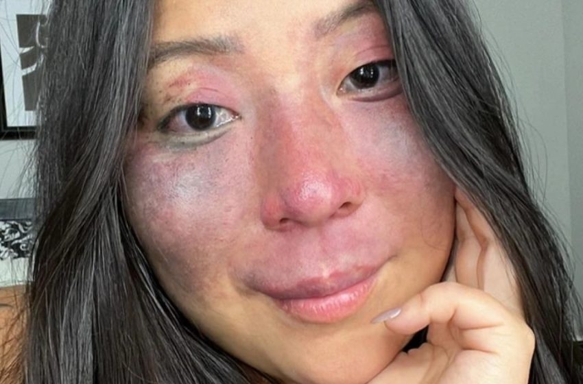  «Estranei la guardano sempre di traverso a causa del prominente neo congenito sul viso»: la ragazza ha osato condividere le sue foto senza trucco e filler!