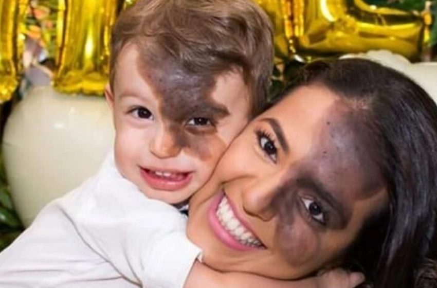  “Non Volevo Che Mio Figlio Si Sentisse Diverso”: Una Mamma Ha Fatto Una Replica Del Neo Scuro Di Suo Figlio Perché Il Ragazzo Non Si Sentisse Imbarazzato Del Suo Viso!