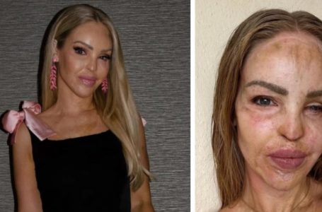 Katie Piper Condivide un Aggiornamento Ispiratore a 16 Anni dalla Sopravvivenza dell’Attacco con l’Acido: Dettagli Inaspettati!