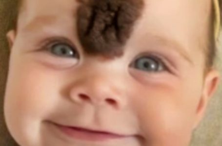 I genitori rimuovono il raro angioma della loro bambina per proteggerla dalla crudeltà: Guarda com’è diventata oggi!