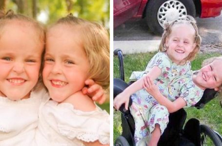 Queste gemelle siamesi sono state separate a 4 anni: ecco come stanno oggi!