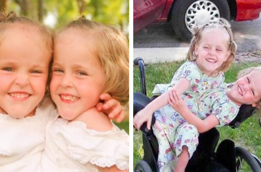  Queste gemelle siamesi sono state separate a 4 anni: ecco come stanno oggi!
