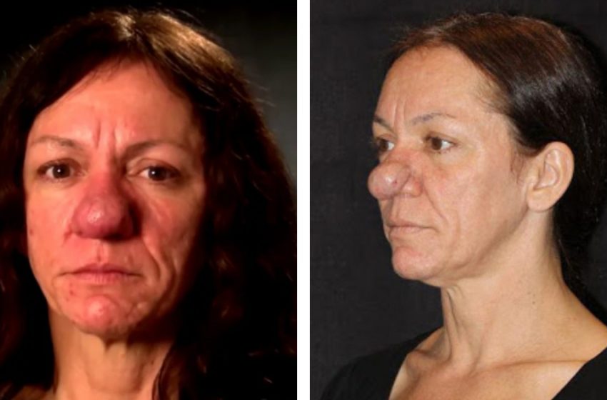 «È Diventata Una Vera Bellezza»: Nata Con un Naso Molto Grande a Causa di una Malattia Rara, Ha Scelto la Chirurgia Estetica!