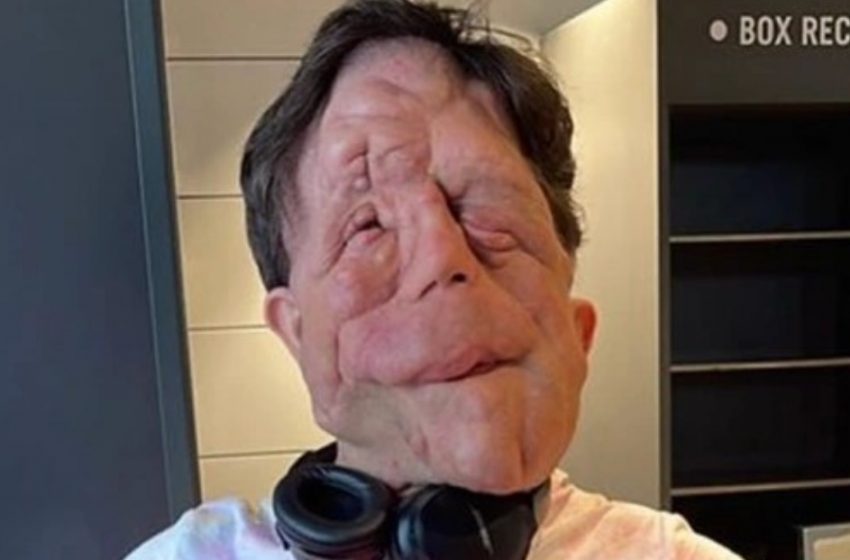 “La Straordinaria Storia di Adam Pearson”: L’Uomo dal Volto Unico che Ha Trasformato la Sua Condizione in una Missione di Vita