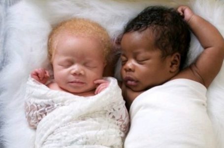 I gemelli unici sono cresciuti e hanno realizzato un servizio fotografico mozzafiato: ecco le loro foto anni dopo!