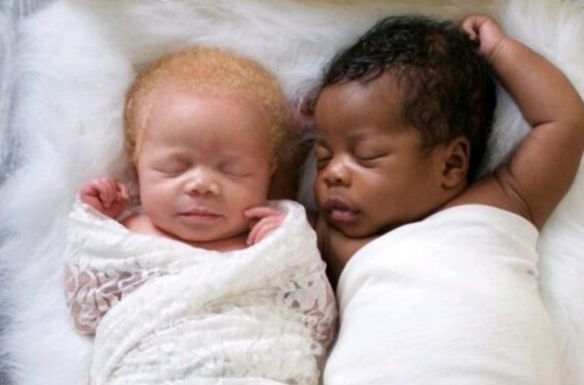 I gemelli unici sono cresciuti e hanno realizzato un servizio fotografico mozzafiato: ecco le loro foto anni dopo!