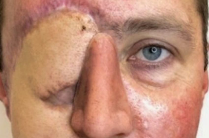 Dopo Aver Perso un Occhio in un Incidente, Si Affida a un Tatuatore per Ridisegnarsi il Volto: Il Risultato è Sbalorditivo!
