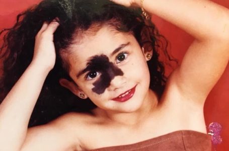 Vittima di bullismo per la sua voglia, ora è una modella che infrange ogni regola: l’hai vista oggi?