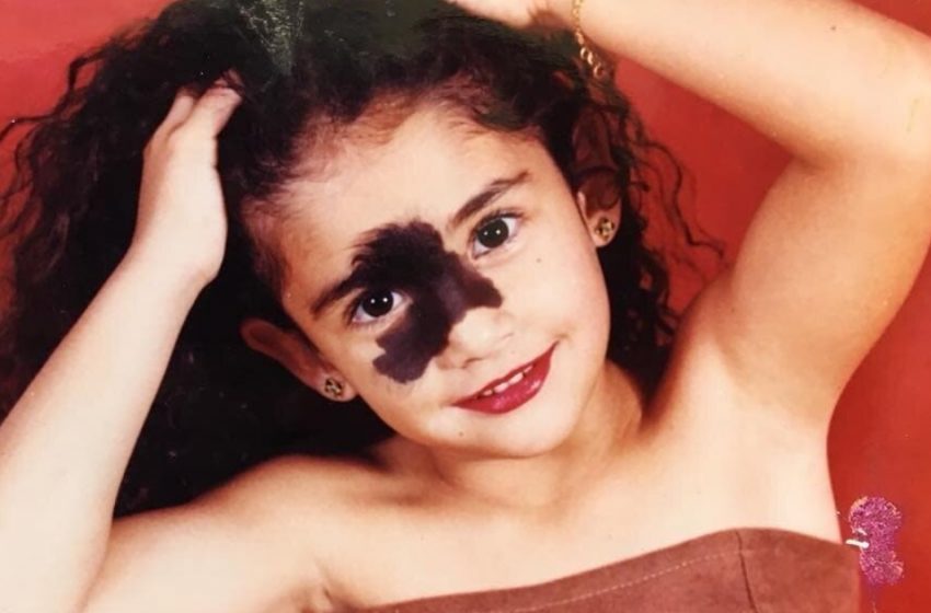  Vittima di bullismo per la sua voglia, ora è una modella che infrange ogni regola: l’hai vista oggi?