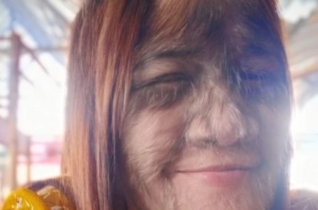 La ragazza più pelosa del mondo» ormai adulta e follemente innamorata! Guarda la sua straordinaria trasformazione!