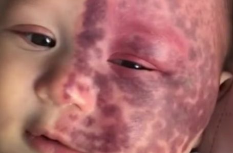 Madre criticata per un controverso trattamento laser mostra la straordinaria trasformazione del figlio dopo tre anni
