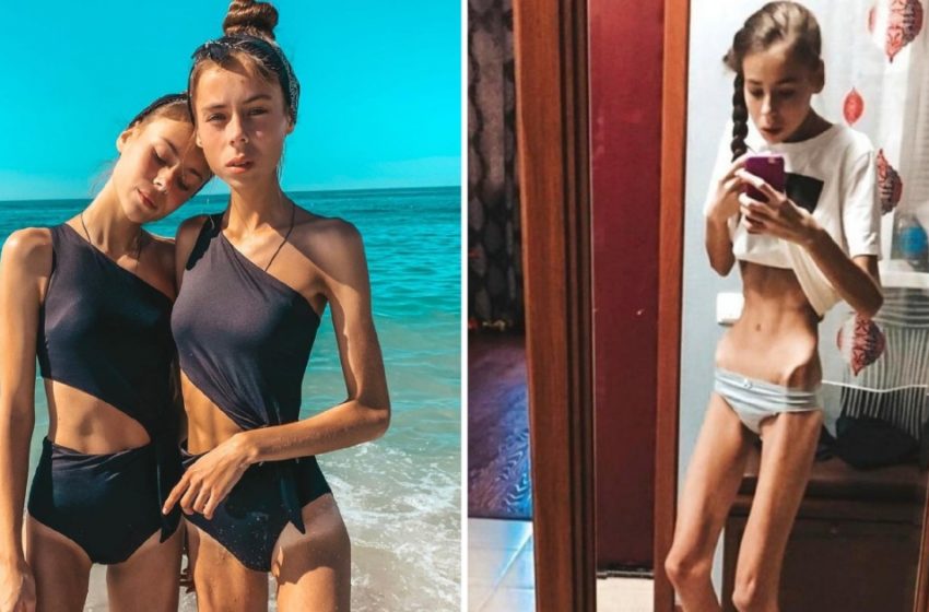  Pesavano appena 38 kg e rischiavano di morire, ma ce l’hanno fatta!: Come sono oggi?