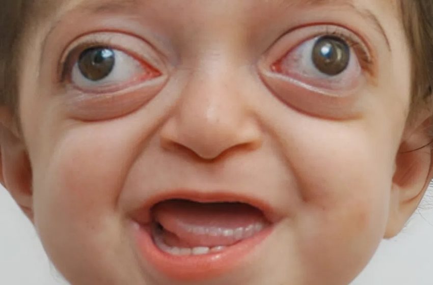  I dottori trasformano il viso insolito di un bambino!: guarda il suo aspetto straordinario dopo tutti i cambiamenti!