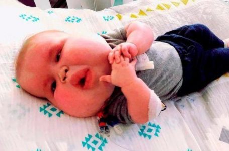 Ecco come appare oggi questo bimbo nato con un viso insolitamente grande!  Guarda le Foto!