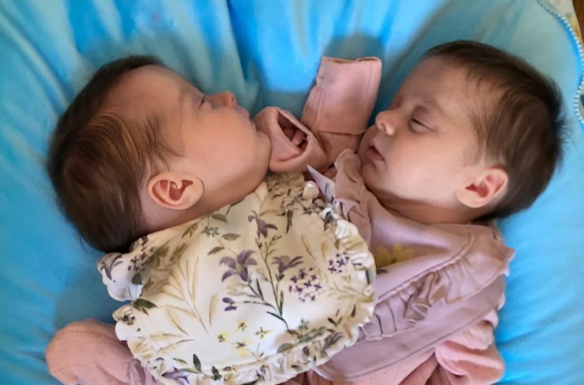  Da gemelle siamesi al torace a bambine indipendenti: le gemelle separate dopo 3 anni—guarda le loro foto