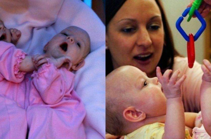  Le Gemelle Siamesi Separate nel 2006: Non Crederai a Come Sono Oggi!